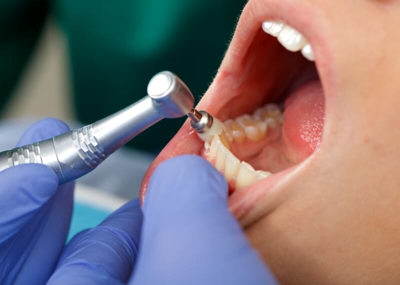 Dental patient getting teeth cleaned