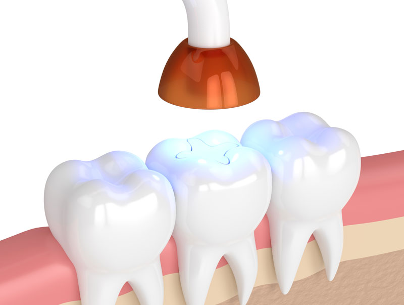 Dental Bonding Procedure