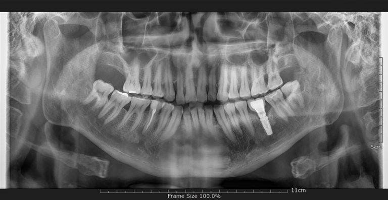 Read more about the article Root Canal VS Dental Implant: Choosing the Best Treatment