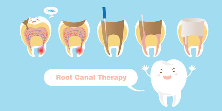 root-canal-vs-dental-implant-choosing-the-best-treatment-hamburg