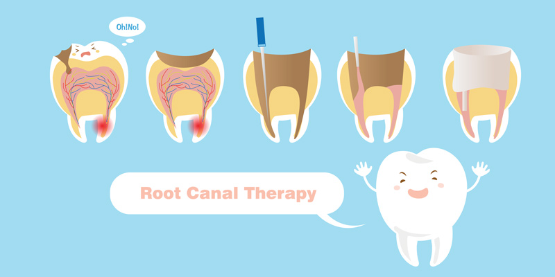 what is a root canal