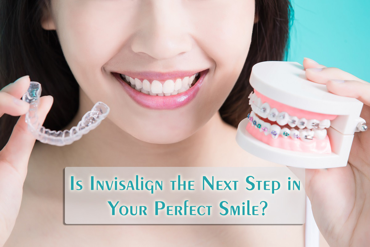 Is Invisalign the Next Step in Your Perfect Smile