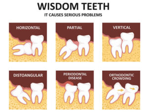 Wisdom Teeth Why We Have Them And When To Remove Them Hamburg Dental   Problems With Wisdom Teeth 300x228 