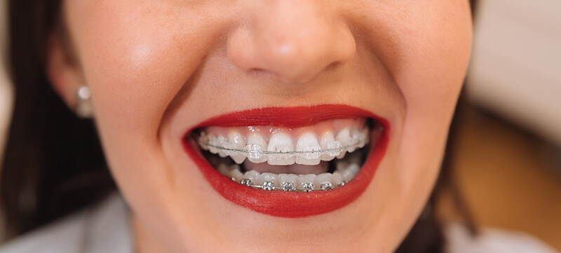 Read more about the article Brace Yourself for the Perfect Smile – How Braces Work