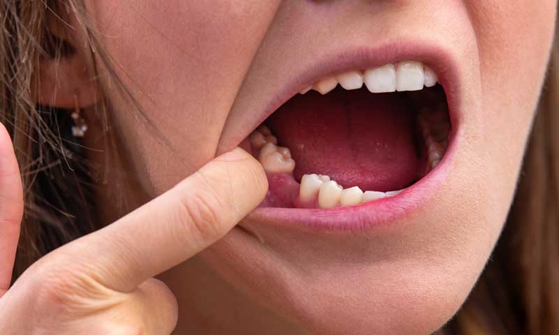 A woman’s missing tooth to be restored with a dental implant