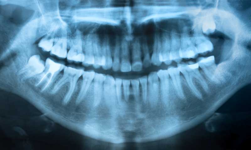 A dental x-ray revealing wisdom teeth placements