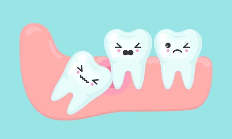 Impacted Wisdom Teeth—Their Causes, Symptoms, and Treatment